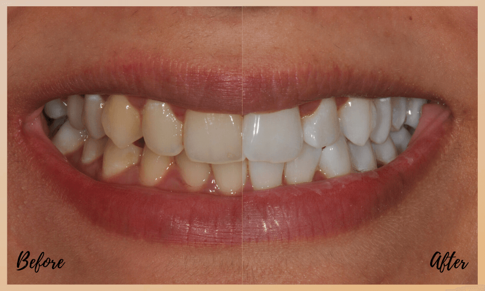 a whiter smile in only two weeks at dental on the banks