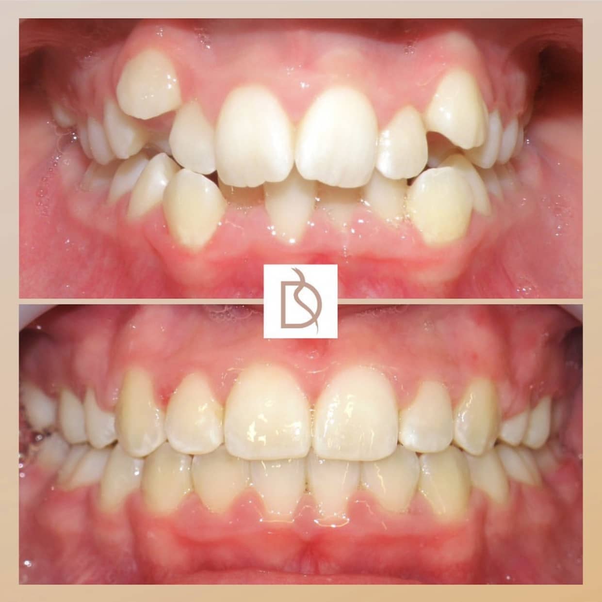 Orthodontist Braces in Bournemouth, Poole and Canford Cliffs