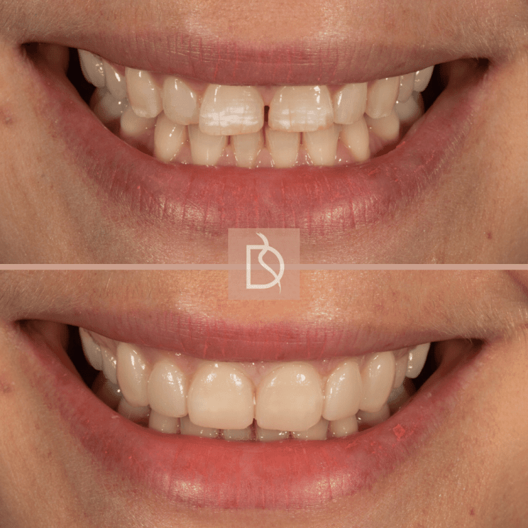 Composite Bonding in Bournemouth Dental on the Banks