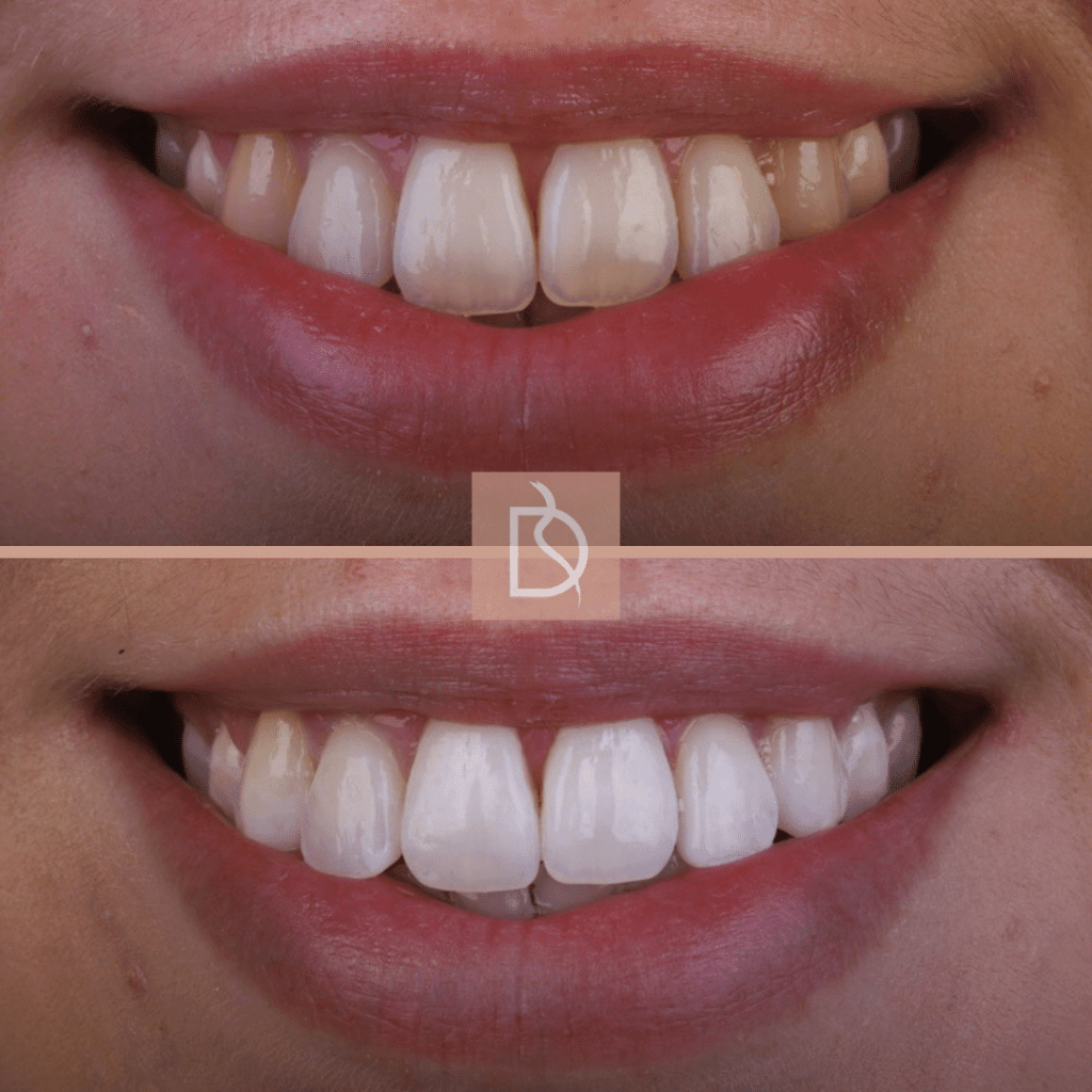 dentist approved teeth whitening enlighten dental on the banks dentist in bournemouth