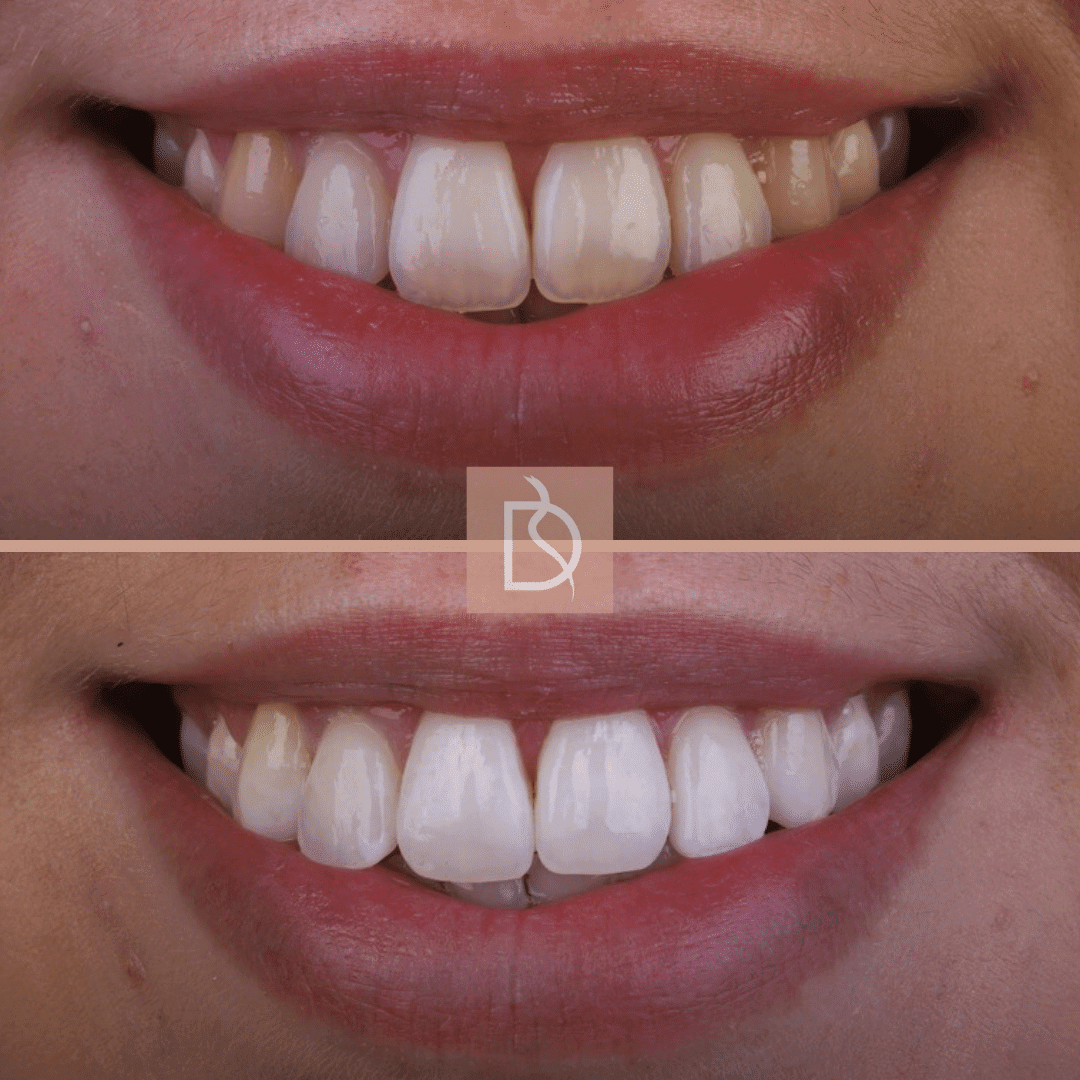 Dentist Approved Teeth Whitening Dental on the Banks