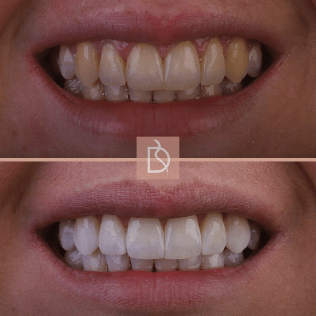 dentist approved teeth whitening enlighten dental on the banks dentist in bournemouth