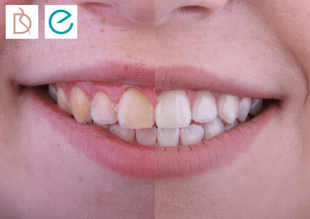 teeth whitening smile makeover in bournemouth