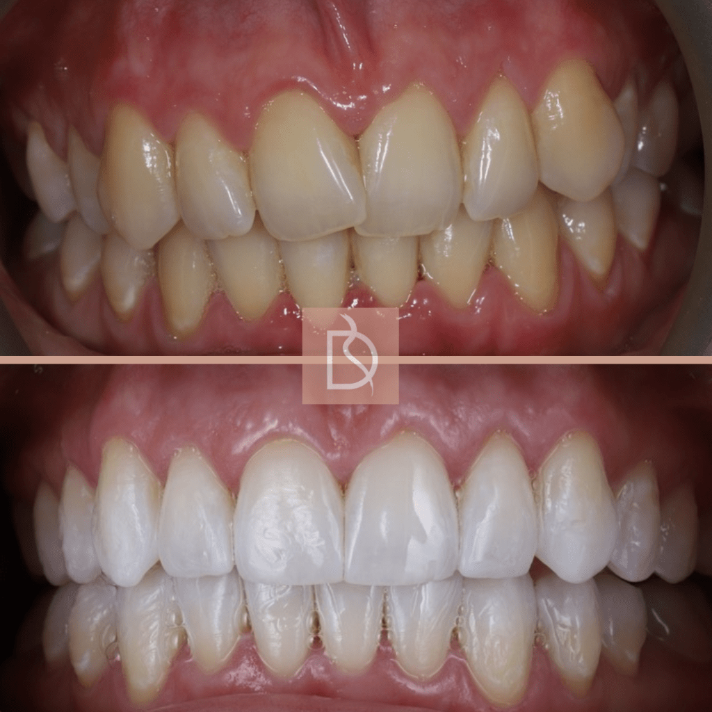 invisalign in poole before and after showing teeth after braces and teeth whitening