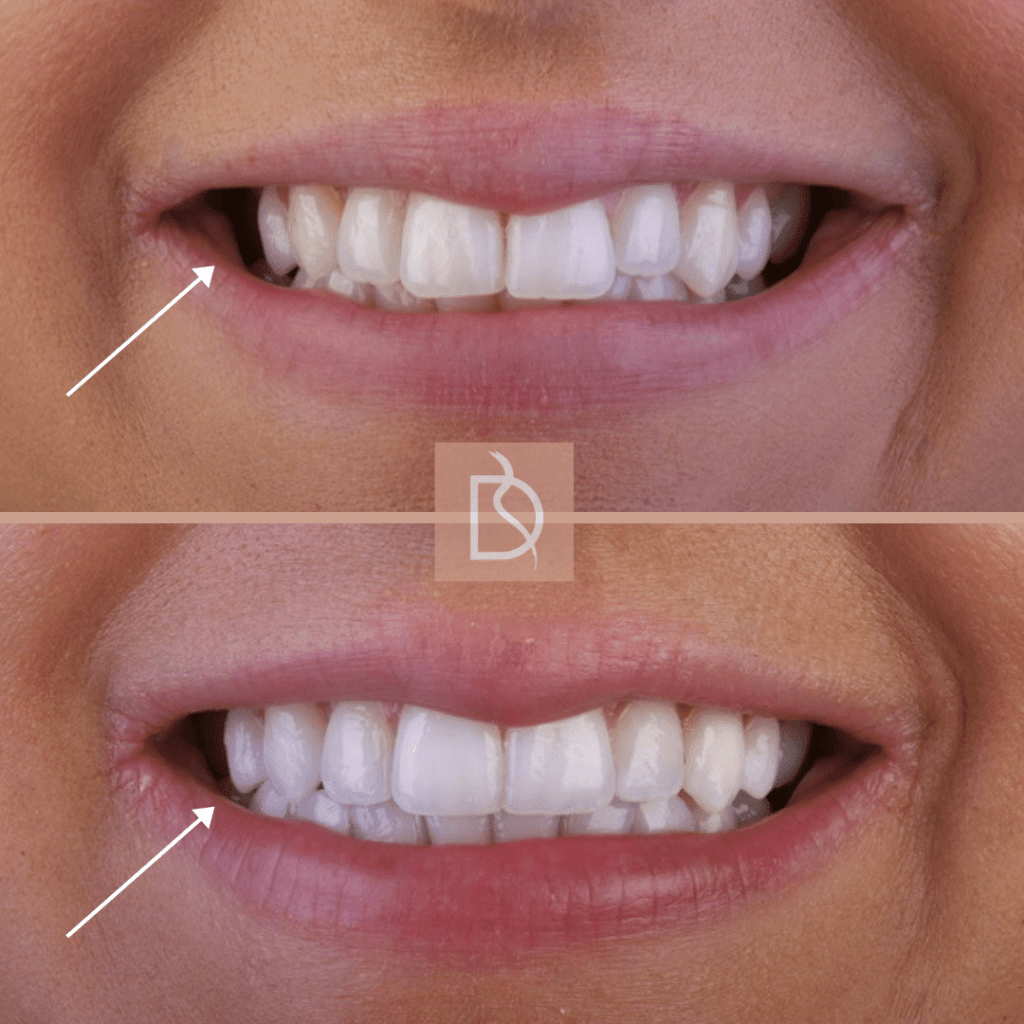 dental on the banks correcting bite function and jaw misalignment with invisalign