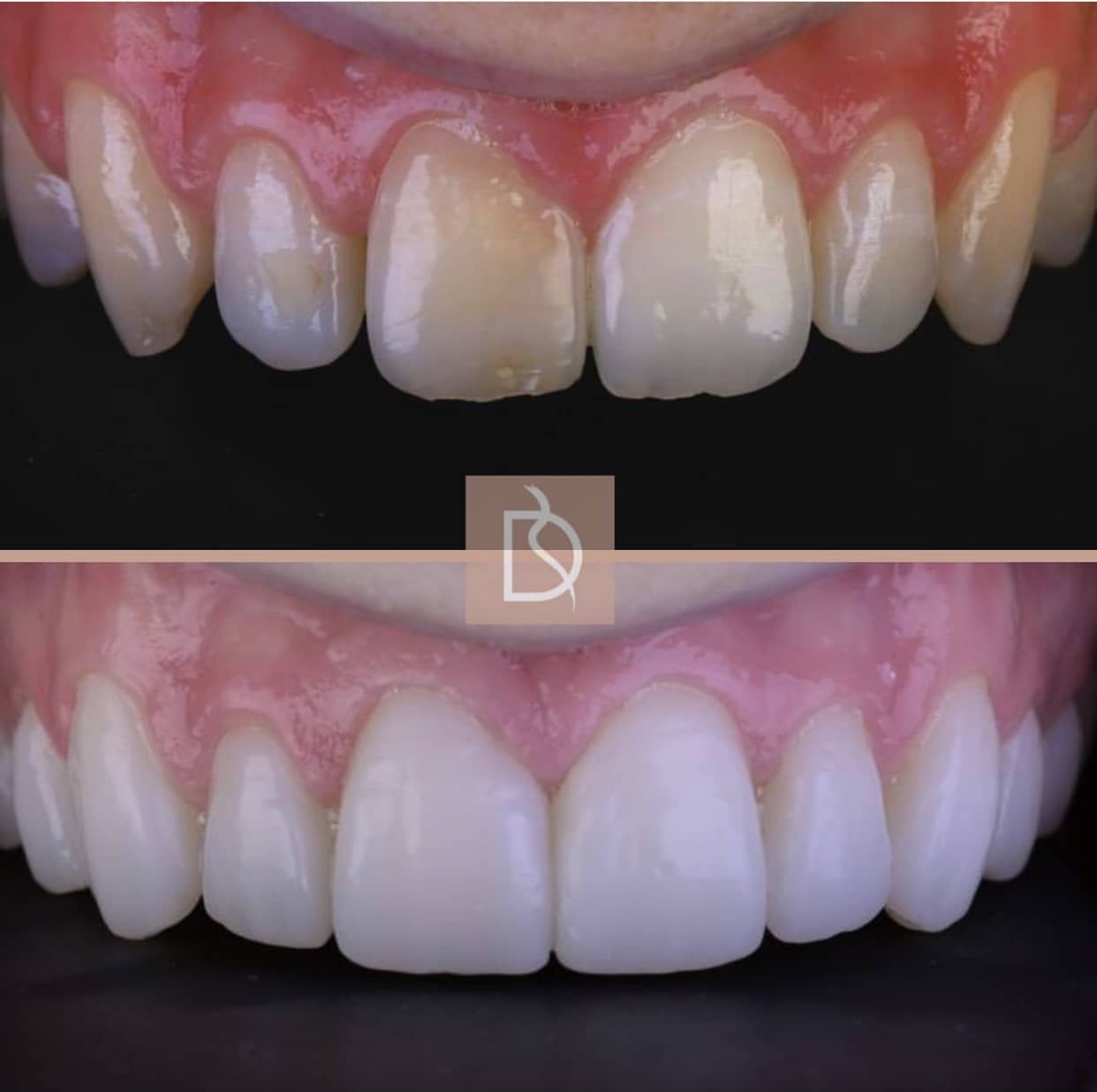 Injection Moulded Composite Bonding Dental on the Banks