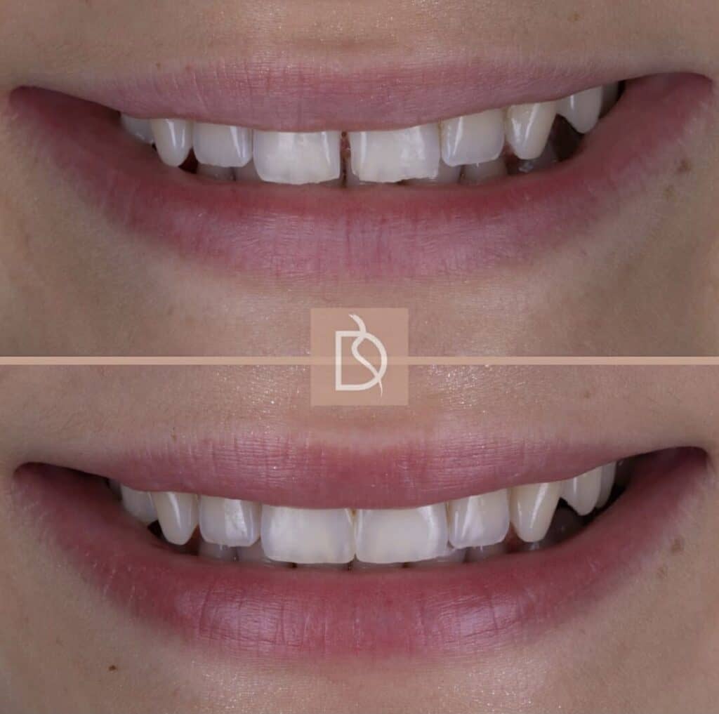 injection moulded composite bonding before and after showing the results of the treatment from dental on the banks