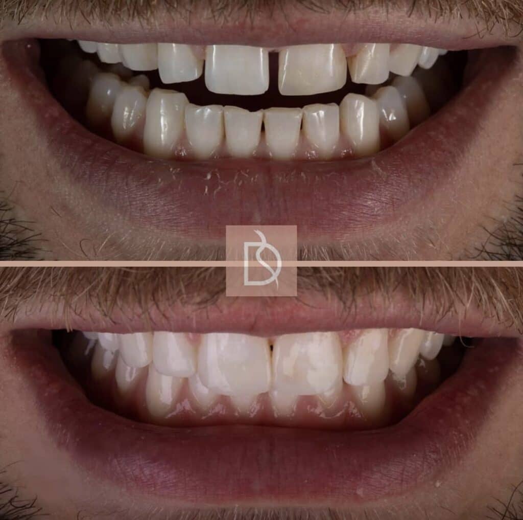 injection moulded composite bonding before and after showing the results of the treatment from dental on the banks