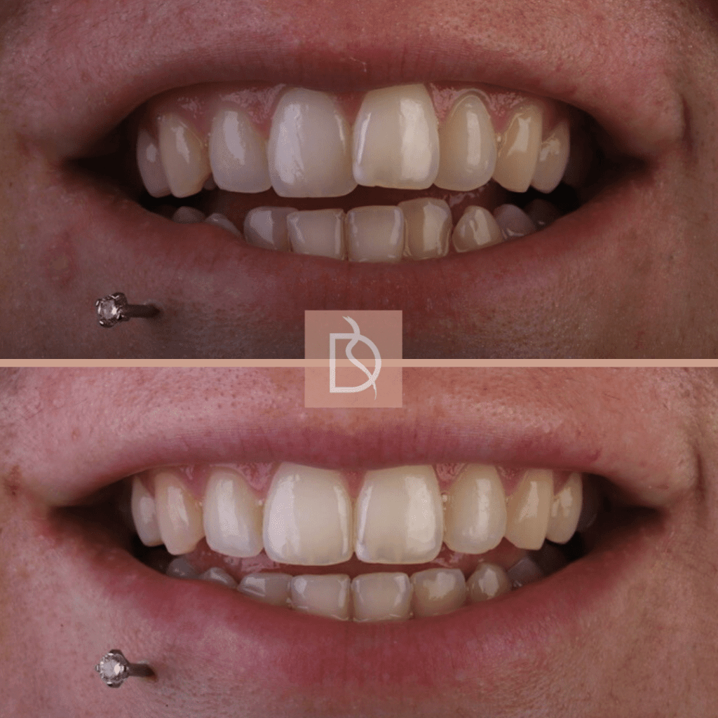 our most popular dental treatments dental on the banks invisalign before and after