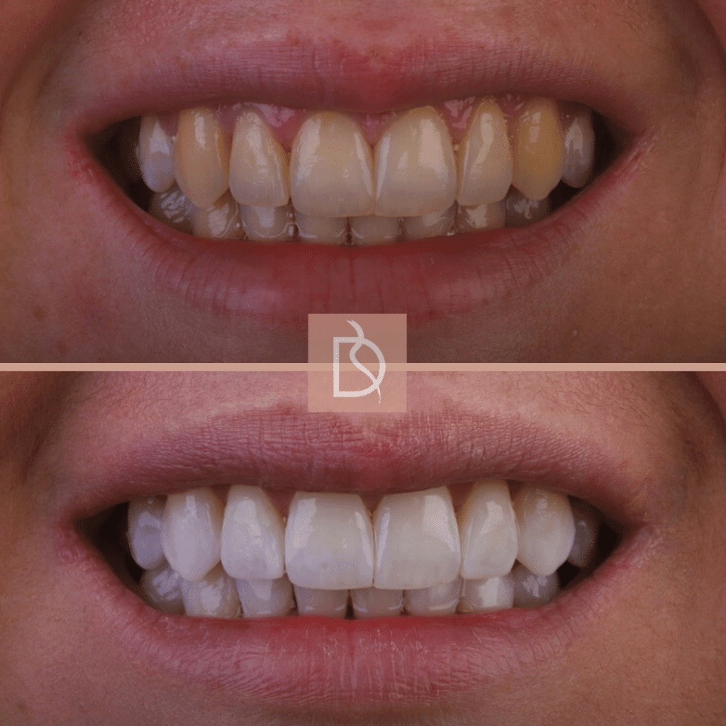 our most popular dental treatments dental on the banks teeth whitening before and after