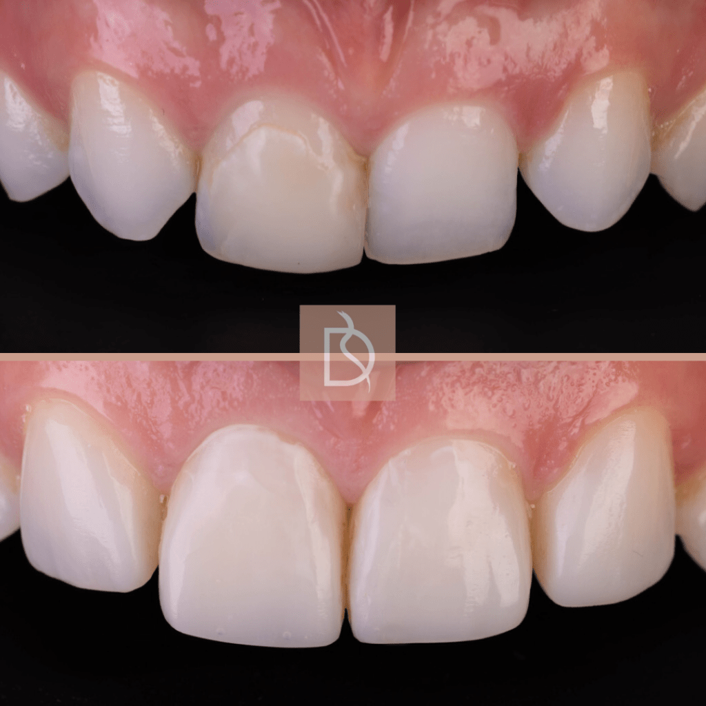 our most popular dental treatments dental on the banks composite bondingbefore and after