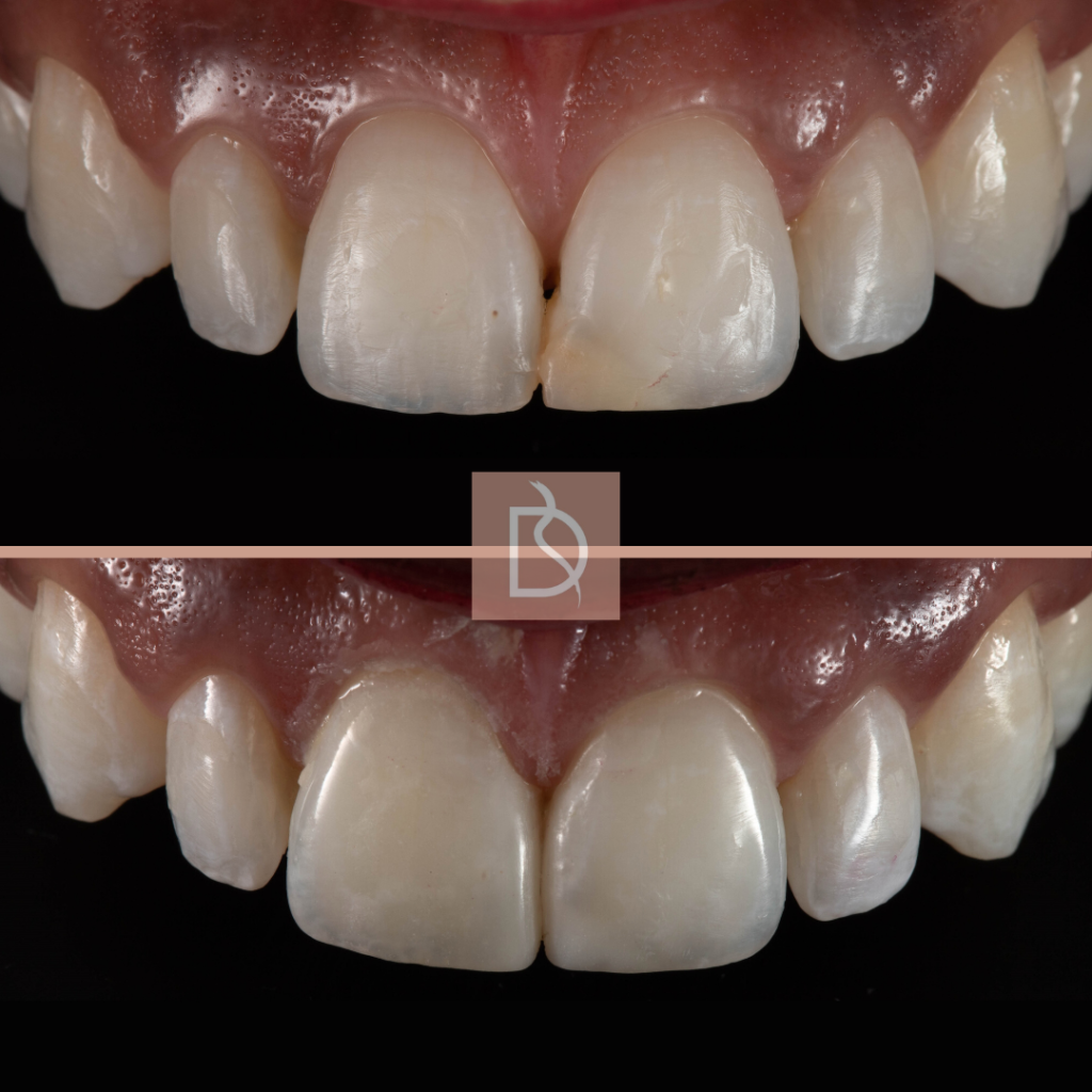 types of composite bonding close up of smile before and after from dental on the banks in bournemouth