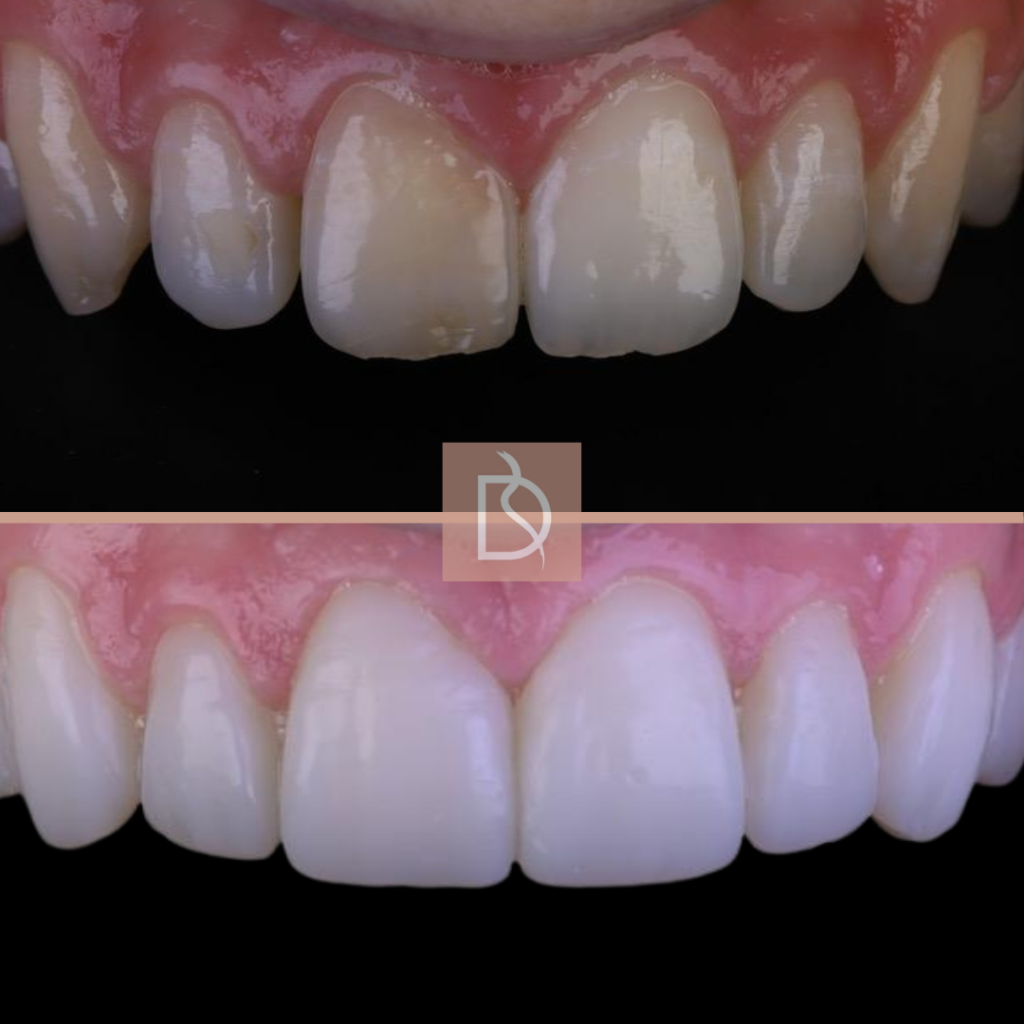 types of composite bonding close up of smile before and after from dental on the banks in bournemouth