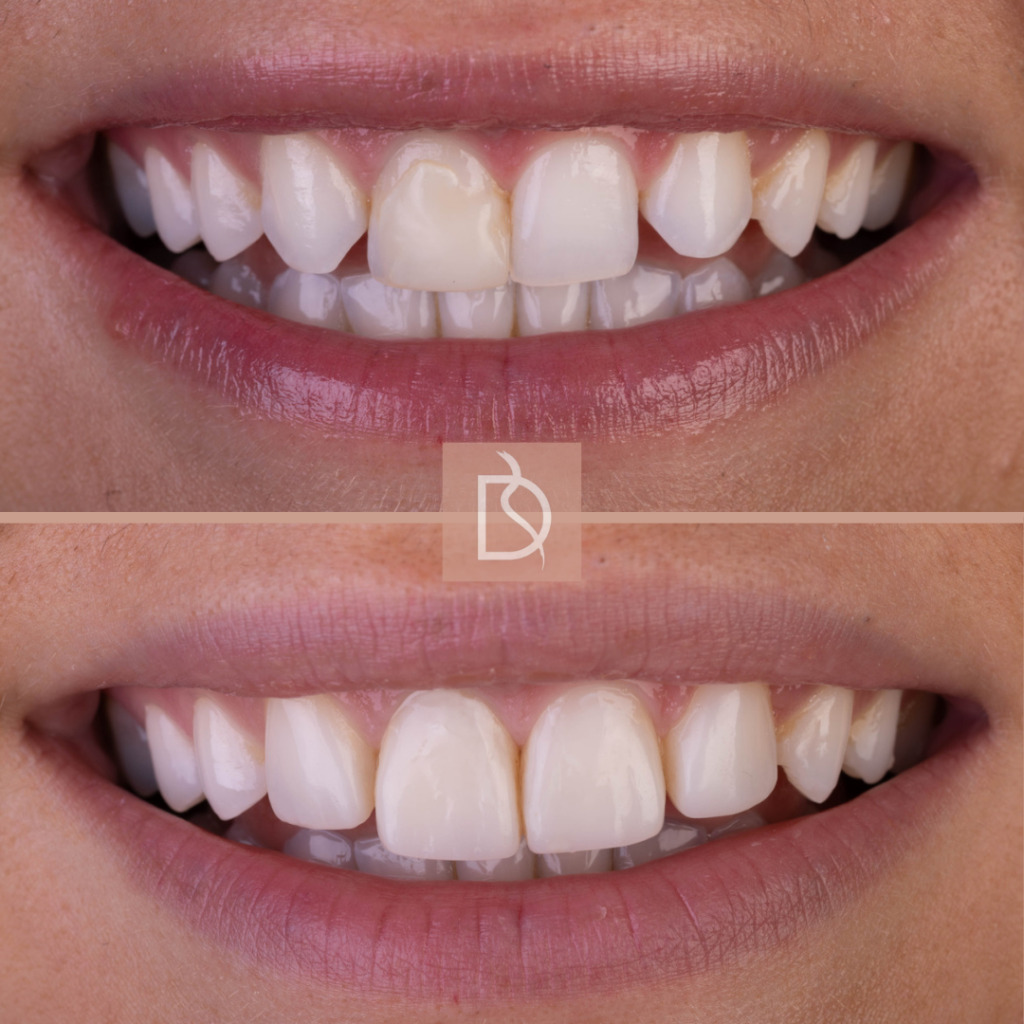 types of composite bonding close up of smile before and after from dental on the banks in bournemouth