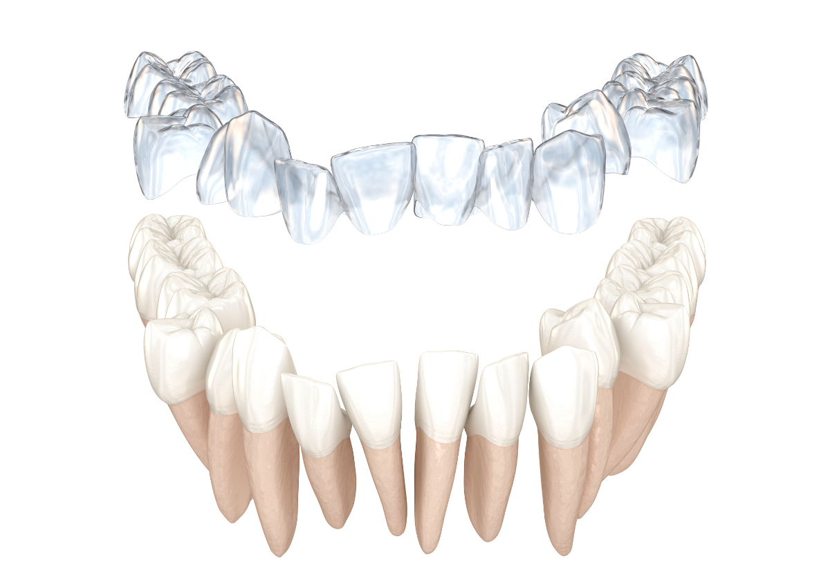 how does invisalign work at dental on the banks dentist in canford cliffs