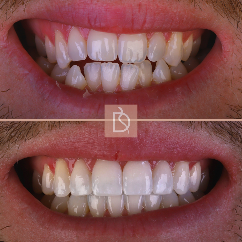 dental on the banks dentist in dorset before and after invisalign and teeth whitening