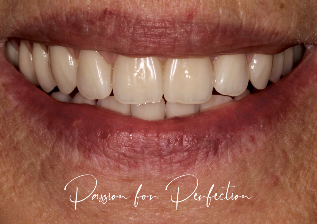 smile of custom dentures from dental on the banks restorative dentist in poole