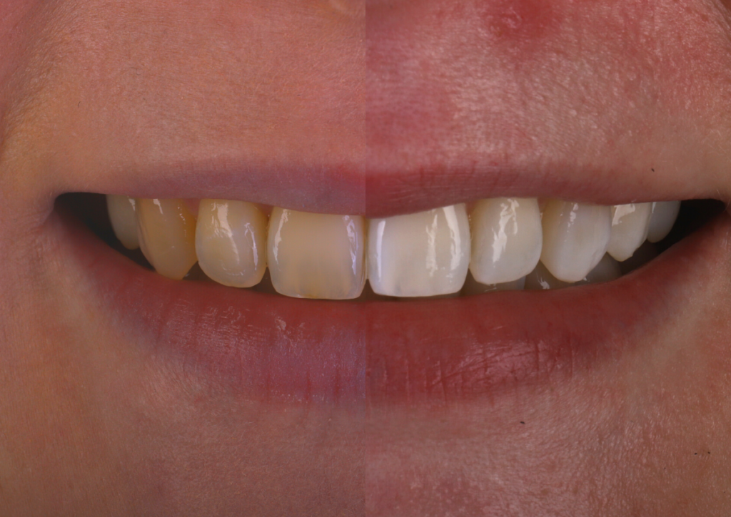 5 signs of healthy teeth teeth whitening before and after at dental on the banks