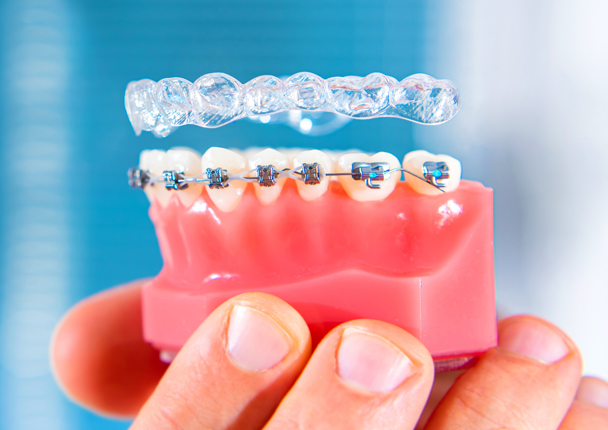 difference between invisalign and fixed braces dental on the banks